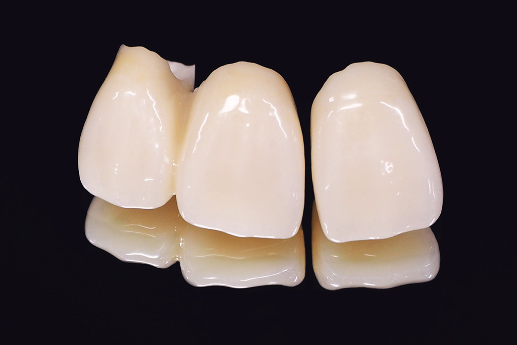 オールセラミック